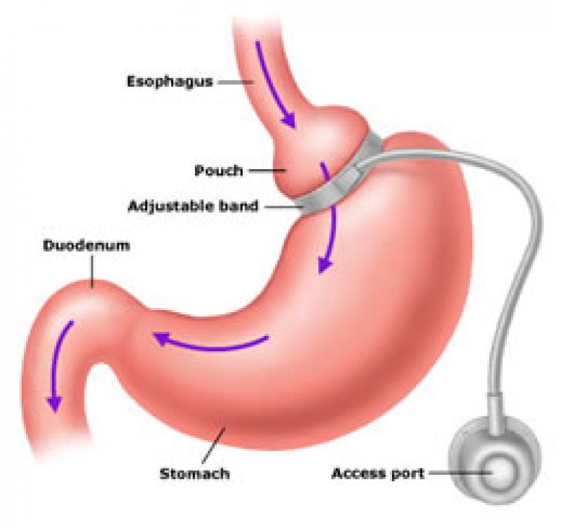 Visualisatie van een maagbandje of gastric banding - Obesitaskliniek Tielt