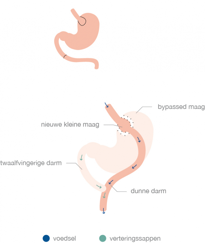 Visualisatie van een gastric bypass of maagoverbrugging - Obesitaskliniek Tielt