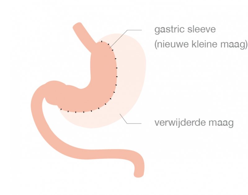Figuur: visualisatie maag voor en na de gastrectomie